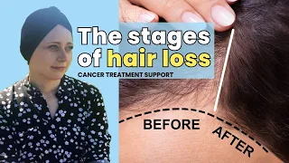 Hair loss Stages • Cancer Treatment Tips