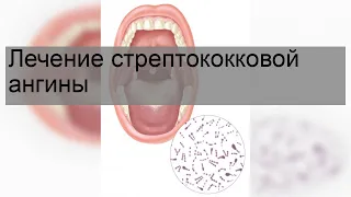 Лечение стрептококковой ангины