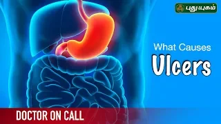 Symptoms & Causes of Stomach Ulcers | அல்சர் நோயின் அறிகுறிகள் | Doctor On Call | 10/06/2019