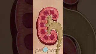 PreOp® 🧬 Advanced Techniques in Kidney Stone Removal #preop #shorts #health 🌐