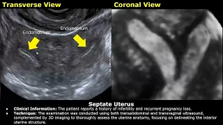 Congenital Uterine Anomalies Ultrasound Reporting | Didelphys, Bicornuate, Unicornuate Uterus USG
