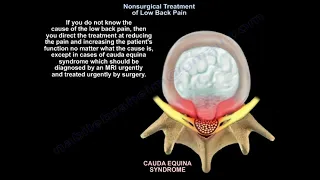 Nonsurgical treatment of Low Back Pain   - Everything You Need To Know - Dr. Nabil Ebraheim