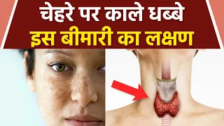 चेहरे पर काले धब्बे होना Thyroid Symptoms | Face Black Spots से Thyroid कैसे होता है | Boldsky