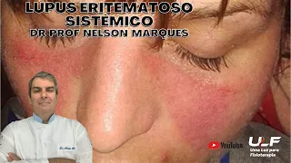 LÚPUS ERITEMATOSO SISTÊMICO - L. E. S. - Dr. Prof. Nelson Marques