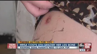 4th grader contracts MRSA