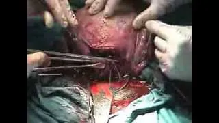 Caesarean Section: Step 5 - Closure of Uterus