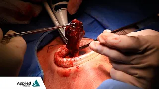 Thyroidectomy Featuring the Alexis® Wound Protector-Retractor
