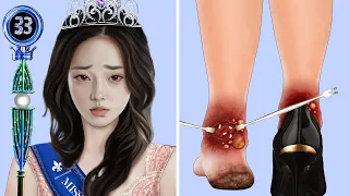 ASMR Removal Big Acne & Maggot Infected Ankle | Severely Injured Animation