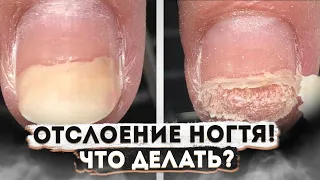 ЧТО ДЕЛАТЬ ПРИ ОНИХОЛИЗИСЕ И КАК ИЗБАВИТЬСЯ ОТ ЭТОЙ ПРОБЛЕМЫ?