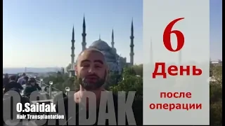 Пересадка Волос На Личном Опыте. 6-ой День После Пересадки