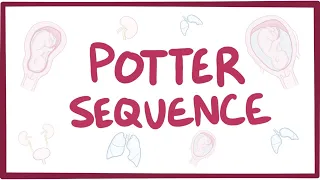 Potter sequence (oligohydramnios) - causes, symptoms, diagnosis, treatment, pathology