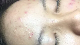 Get hidden acne