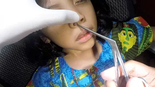 Chewing Gum Stuck in Girl's Nose . Can It Be Removed?