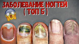 топ 5 заболеваний на ногтях