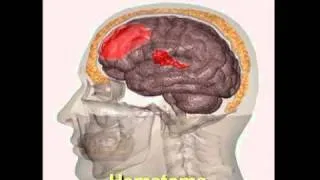 ?Como Se Lesiona el Cerebro? (Una Fuerza Positiva: Modulo 3)