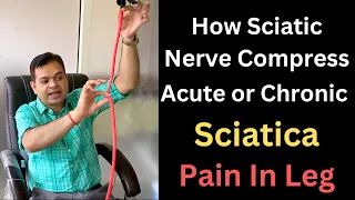 Acute or Chronic Sciatica, Nerve Compression, Leg Pain Relief, Sciatica Pain Treatment