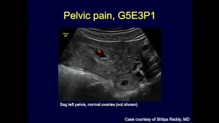 Pelvic Pain Positive Pregnancy Test