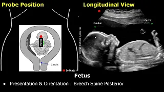 Obstetric Ultrasound Probe Positioning | Pregnant Uterus & Fetus Transducer Placement USG Scan