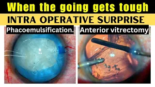 When the going gets tough. Intraoperative surprise - Phacoemulsification & Anterior vitrectomy