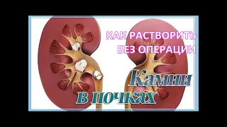 Как РАСТВОРИТЬ Камни в ПОЧКАХ и Мочевом Пузыре без операции и дробления / Фролов Ю.А.