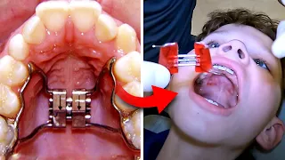 Getting Expander OFF… what happens when you get your Expander Off | McKinney Orthodontist