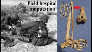 Sawbones 1945 - Archeological evidence of first aid and emergency surgery on WWII German soldiers