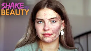 Doctors Are Baffled By My Mystery Skin Condition | SHAKE MY BEAUTY