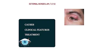 STYE | CLINICAL FEATURES | TREATMENT