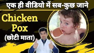 चिकन पोक्स के लक्षण, कारण, उपचार और सावधानी | Chicken pox kaise thik hoga hai