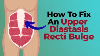 Flatten Upper Abdominal Bulging (Upper Diastasis Recti Bulge)