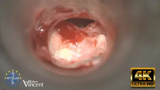 Anterior TM Perforation. Type 1 Tympanoplasty With Total Flap Removal & Canalplasty