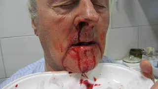 Management of nosebleed