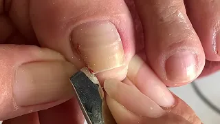 deep leg skin cutting technique#266