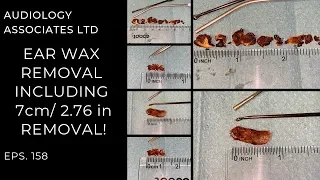 EAR WAX REMOVAL INCLUDING 7CM/2.76IN REMOVAL - EP158