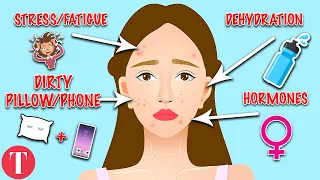 10 Types Of Acne And What They Mean