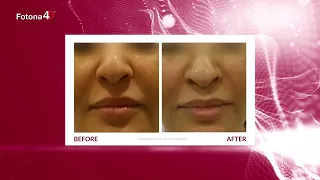 Fotona4D - Non-invasive Laser Facelift