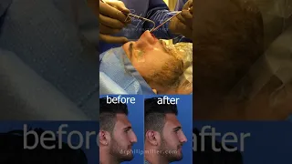 Operating Room Review: A Successful Rhinoplasty and Septoplasty Revealed