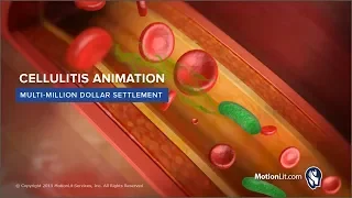 Soft Tissue Damage 3D Animation Shows Developing Cellulitis Leading to Pain Impulse Trigger