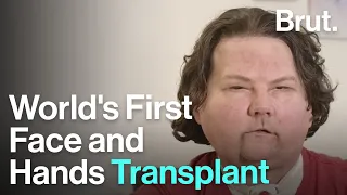 World's First Face and Hands Transplant