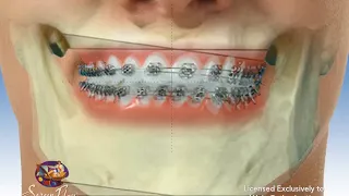 Mandibular Asymmetry