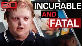 Rare and mysterious disease causes skin to fall off | 60 Minutes Australia