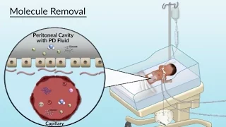 Peritoneal Dialysis by S. Su, A. Olszewski | OPENPediatrics