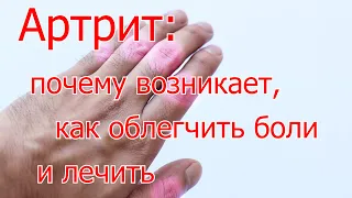 Артрит: чому виникає, як полегшити болі та лікувати // Здоров’я. Діалог