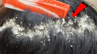 Dandruff Scratching and Combing - Huge Flake - Itchy Dry Scalp On Long Hair Guy #26