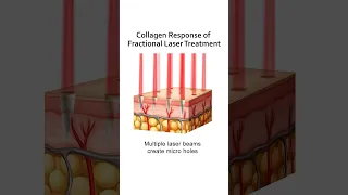 Exceeding Collagen Induction Limits can Damage the Skin #lasertreatment