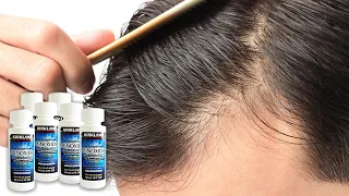 Can You Maintain Minoxidil Grown Hair After Stopping Minoxidil?