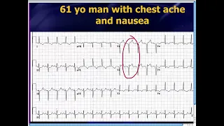 Amal Mattu's ECG Case of the Week_ Oct 28, 2013