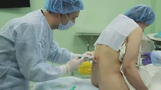 Эпидуральная анестезия