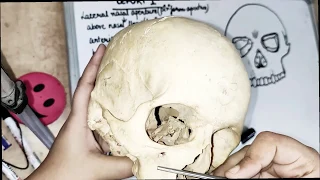 lefort 1 fracture - line and clinical features