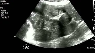 Small bowel obstruction on ultrasound